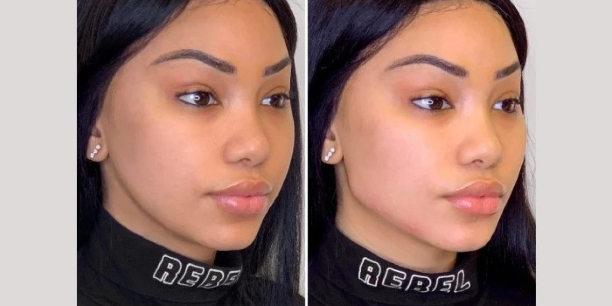 Best Aesthetic Clinic in Dubai for Expert Anti Aging Thread Lift Facial